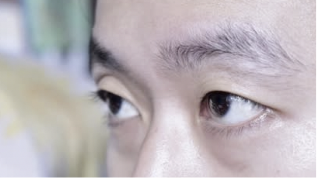 眼皮下垂恐是重症徵兆！醫揭「危險警訊」：不要再當成皮膚鬆垮