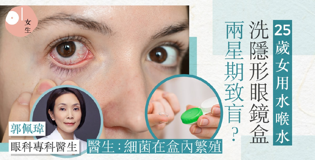 25歲女生長期用水喉水洗隱形眼鏡盒-感染罕見眼疾兩周內致失明